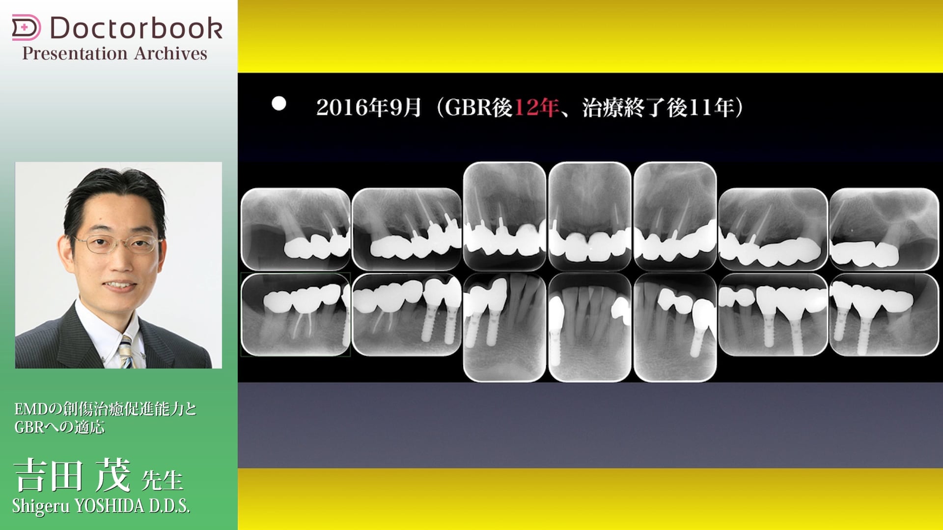 EMDの創傷治癒促進能力とGBRへの適応