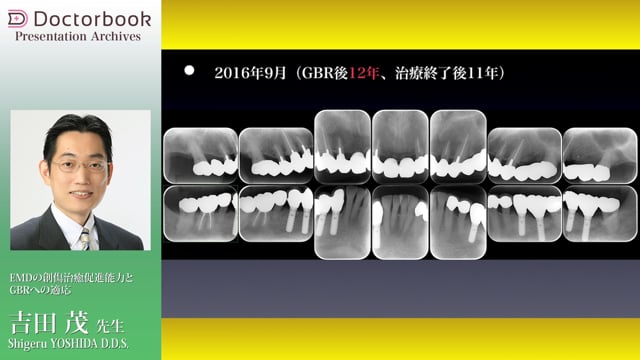 EMDの創傷治癒促進能力とGBRへの適応