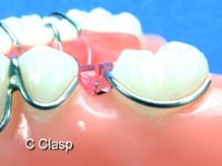 C Clasps Dental Appliance
