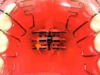 Expansion Screw Dental Appliance
