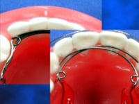 Lap Springs Dental Appliance