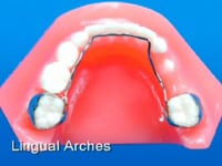 Lingual Arch Dental Appliance