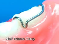 Half Adams Dental Appliance