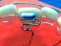 Recurved Finger Spring Dental Appliance