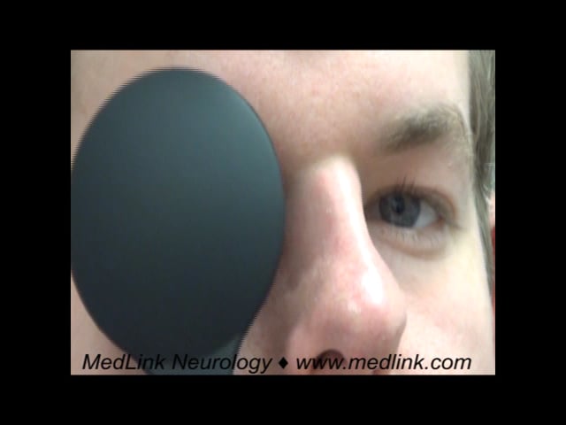 Decompensated congenital left fourth nerve palsy in a young man