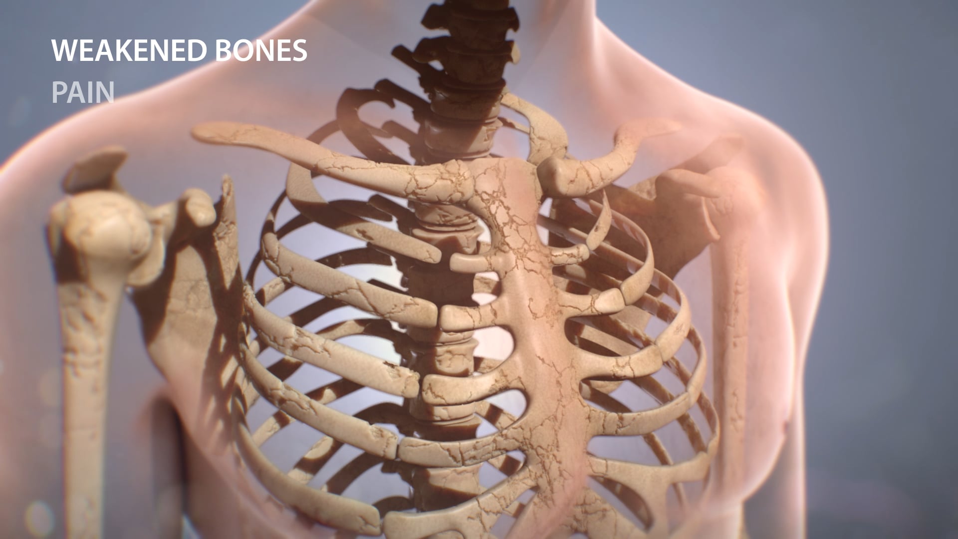 3D medical samples - WebMD_3D_Multiple Myeloma_Final-2 on Vimeo