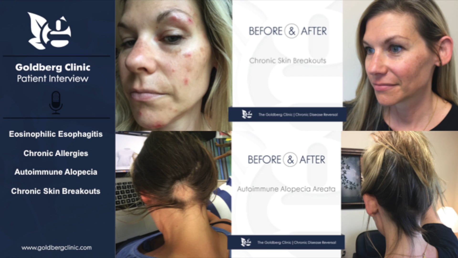 Reversing Eosinophilic Esophagitis, Autoimmune Alopecia, Skin Breakouts