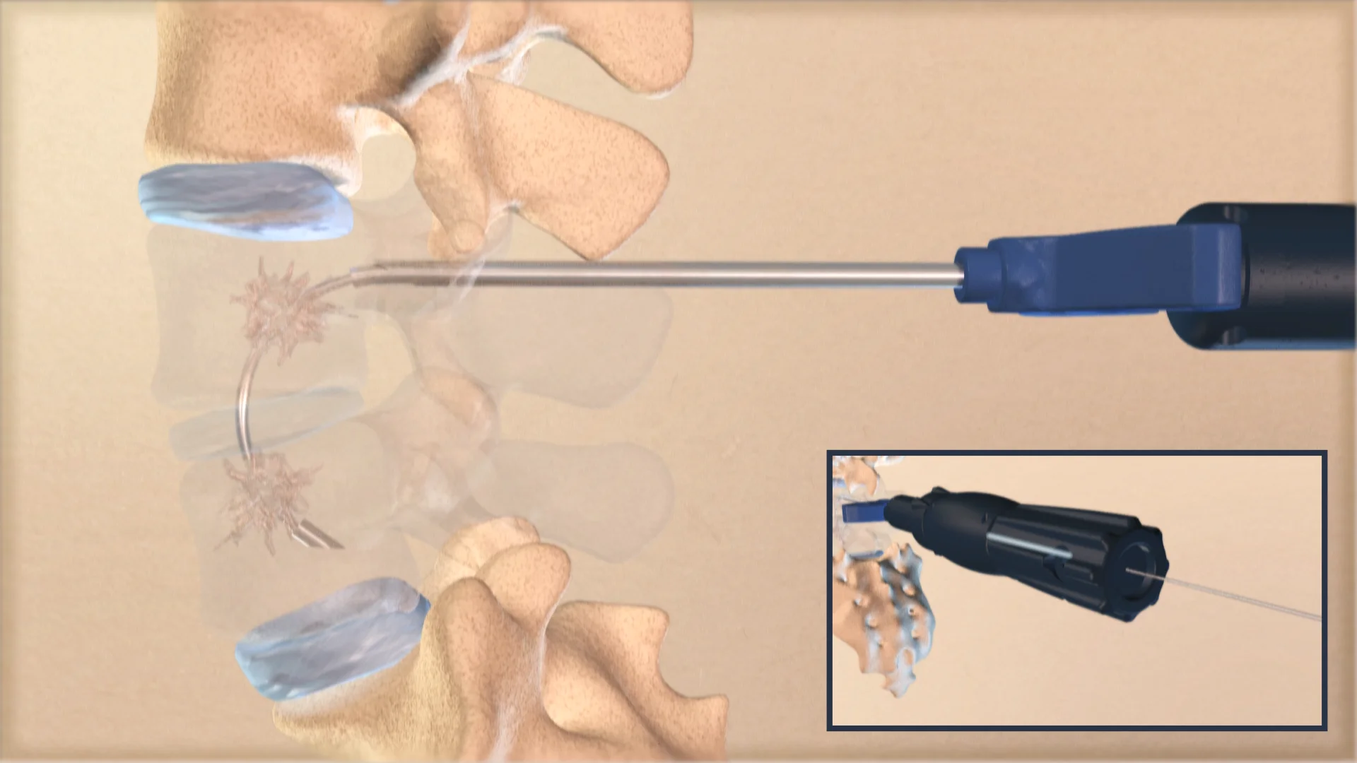 Evolution in Spinal Fusion on Vimeo