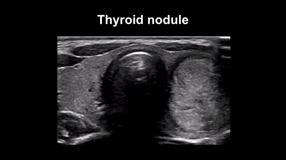 Thyroid nodules