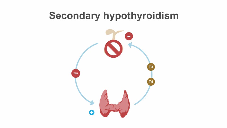 Hypothyroidism