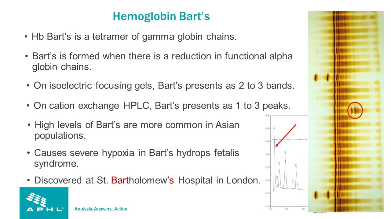 Alpha Thalassemia Newborn Screening In The United States On Vimeo   643359507 F8d41140875334c310f995617612cbdae352be3fdee10f54e8ff874d18bd47a3 D