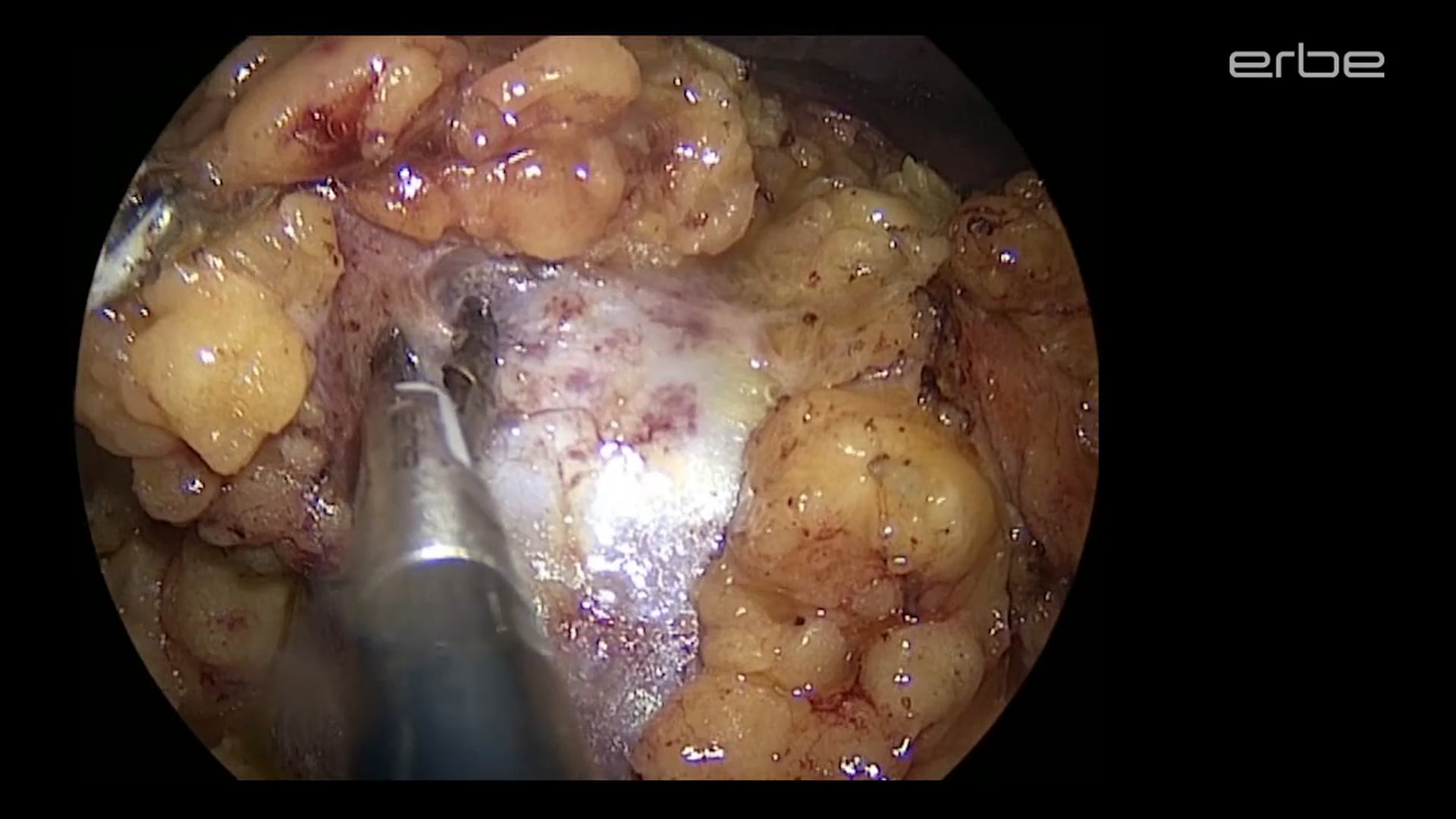 Laparoscopic partial nephrectomy with LAP BiSect Micro