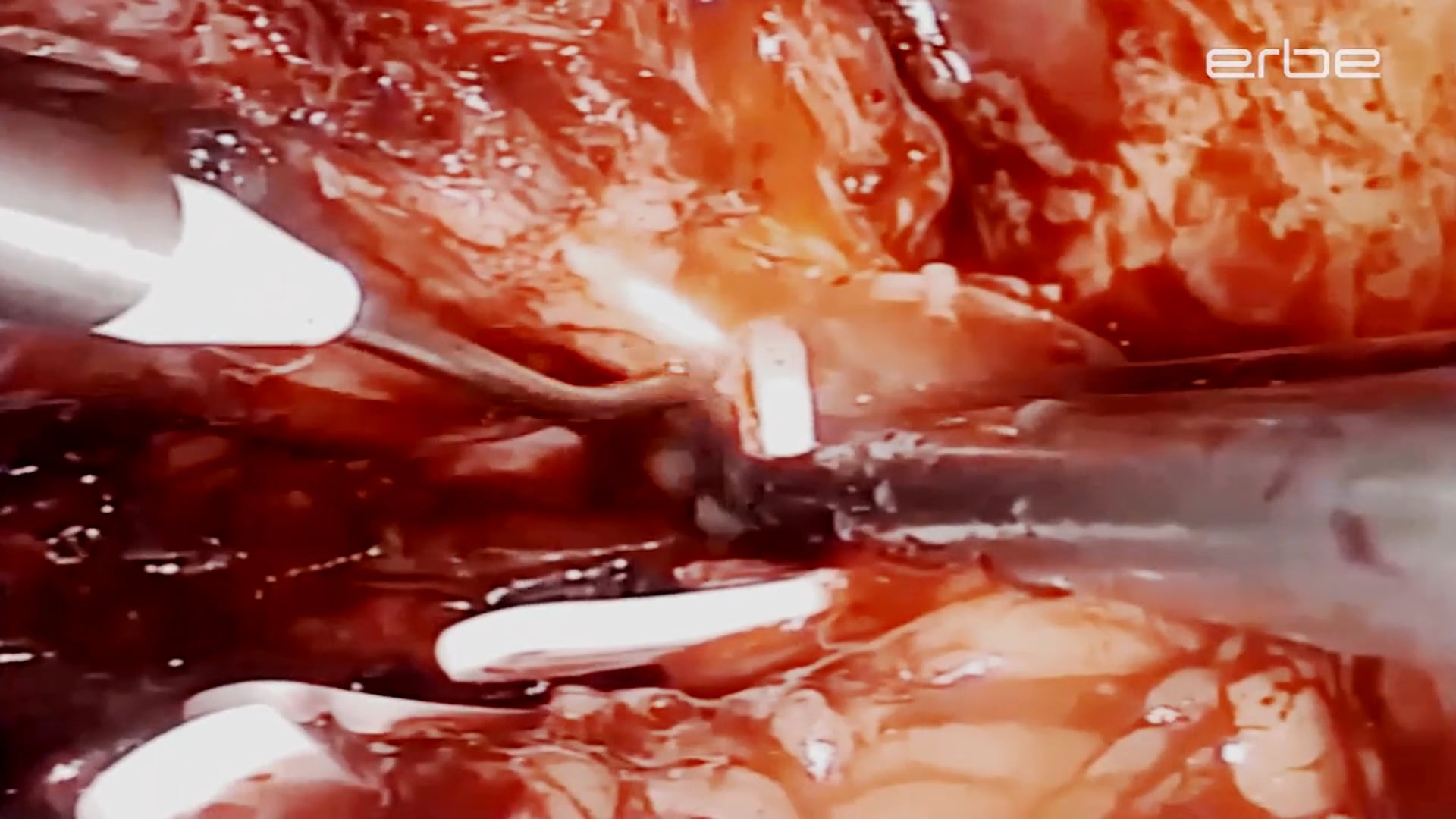 Nerve sparing laparoscopic radical prostatectomy with hydrodissection, intrafascial technique