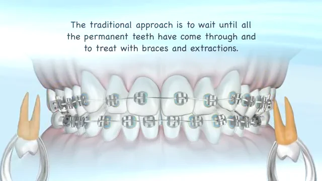 What is Open Mouth Posture? - Maple Dental Hygiene Care