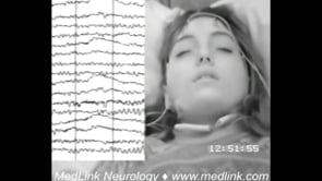 Typical absence seizures with continuous and repetitive myoclonic jerking of the eyebrows