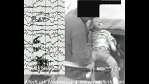 Typical absence seizures of structural myoclonic absence epilepsy