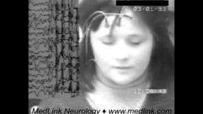 Typical absence seizures with vertical nystagmus