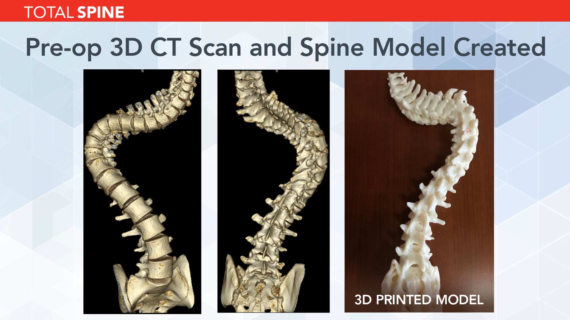 The Use of 3D-Printed Spine Models in Complex Spinal Deformity Surgery