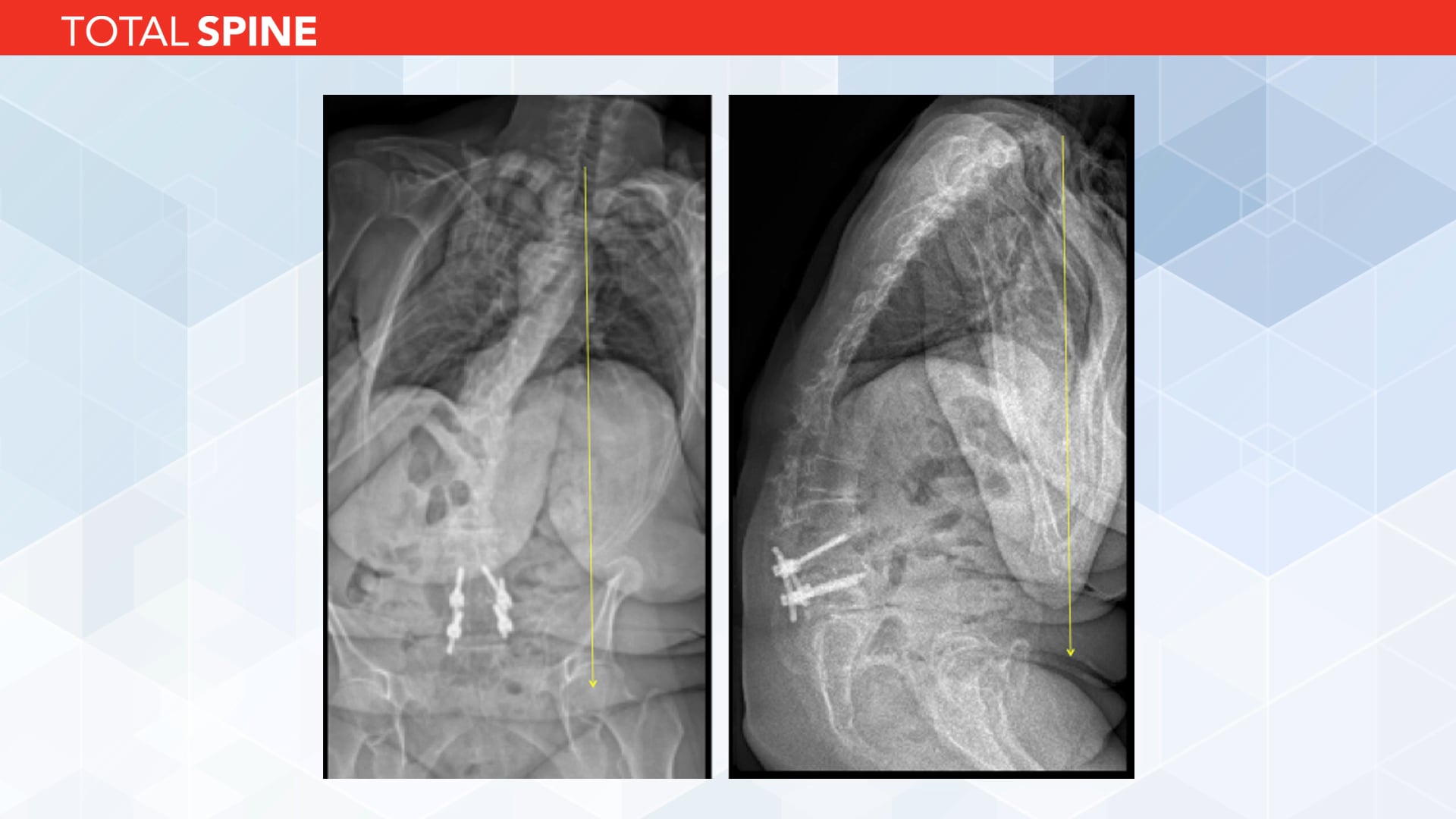 The Kickstand Technique for the Correction of Coronal Imbalance