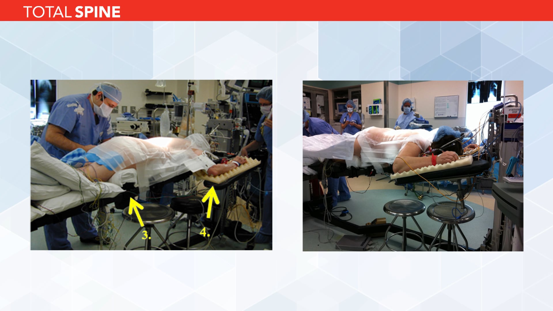 Patient Positioning During Complex Spinal Deformity Surgery