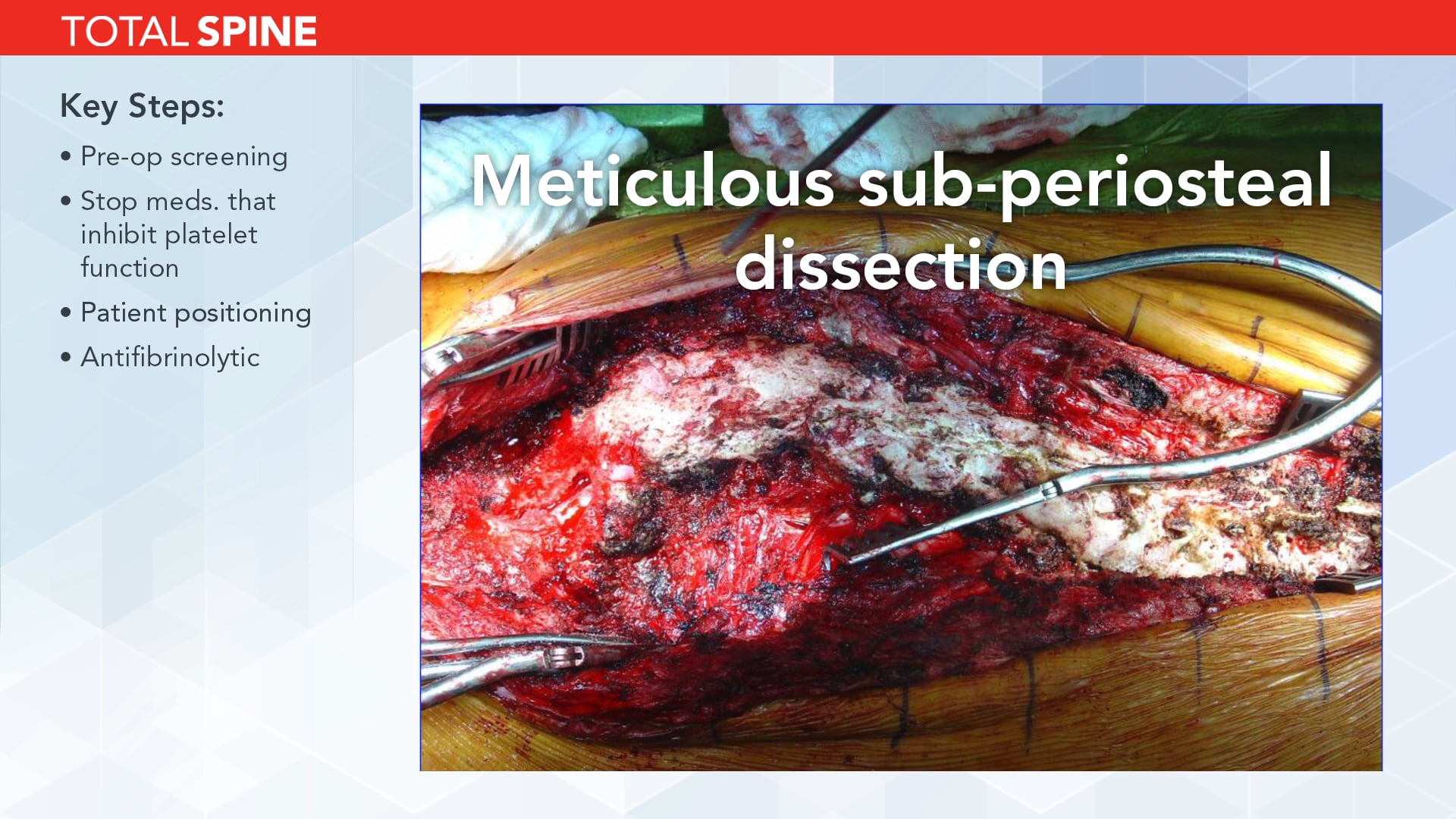 Tips for Minimizing Blood Loss in Complex Spinal Deformity Surgery