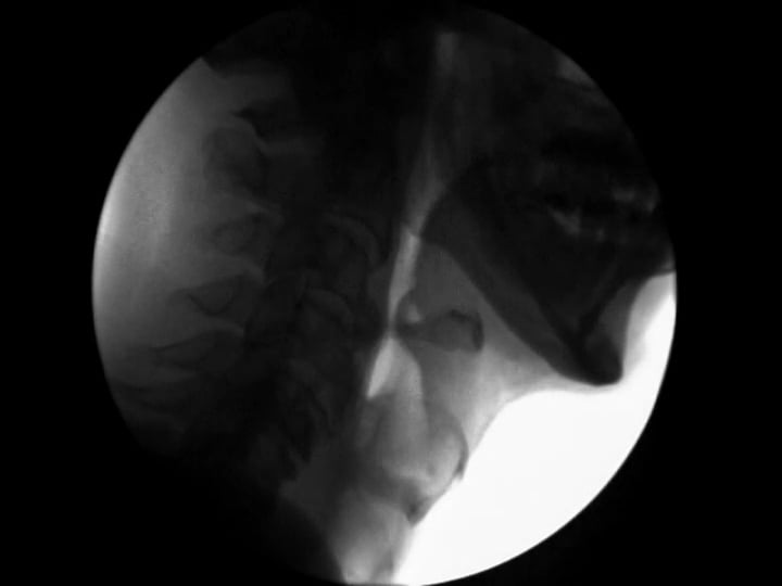 Modified Barium Swallow Study - Aspiration