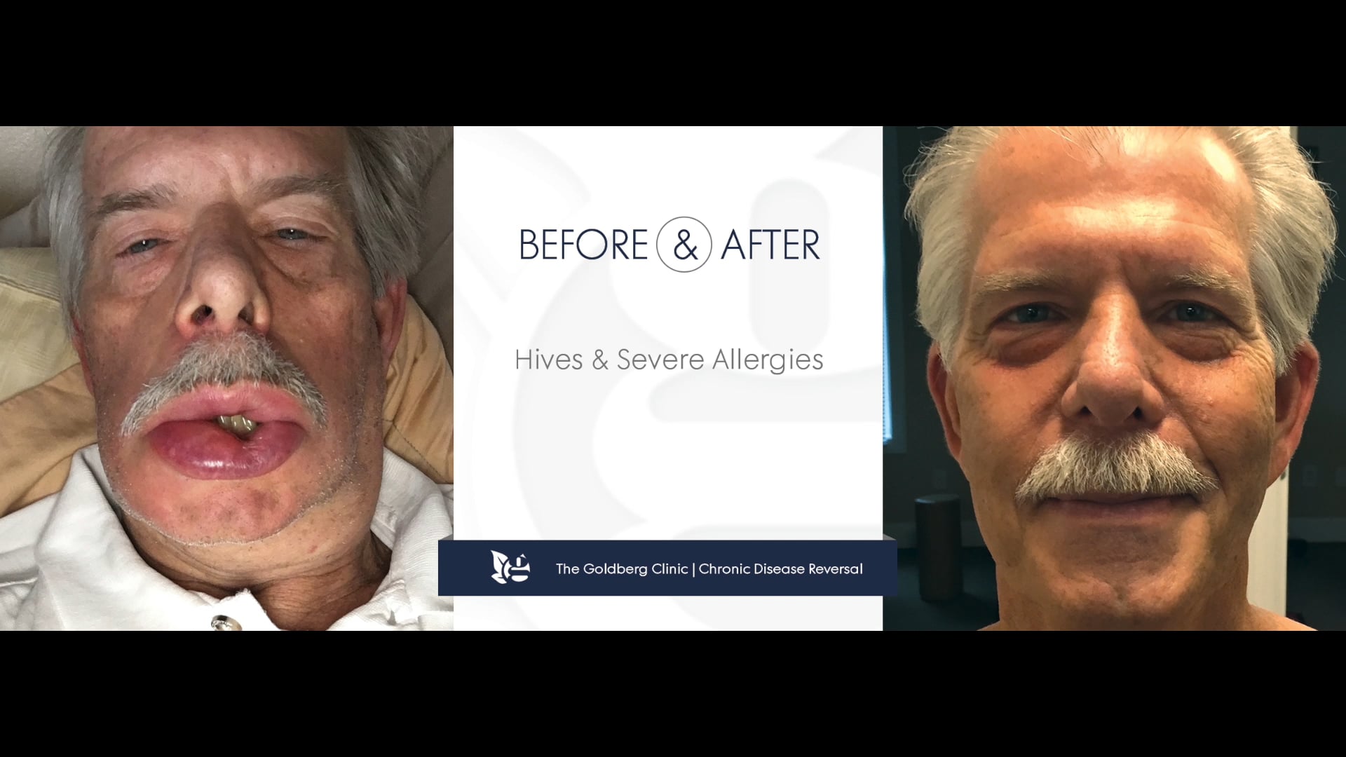 Reversing Hives and Severe Allergies