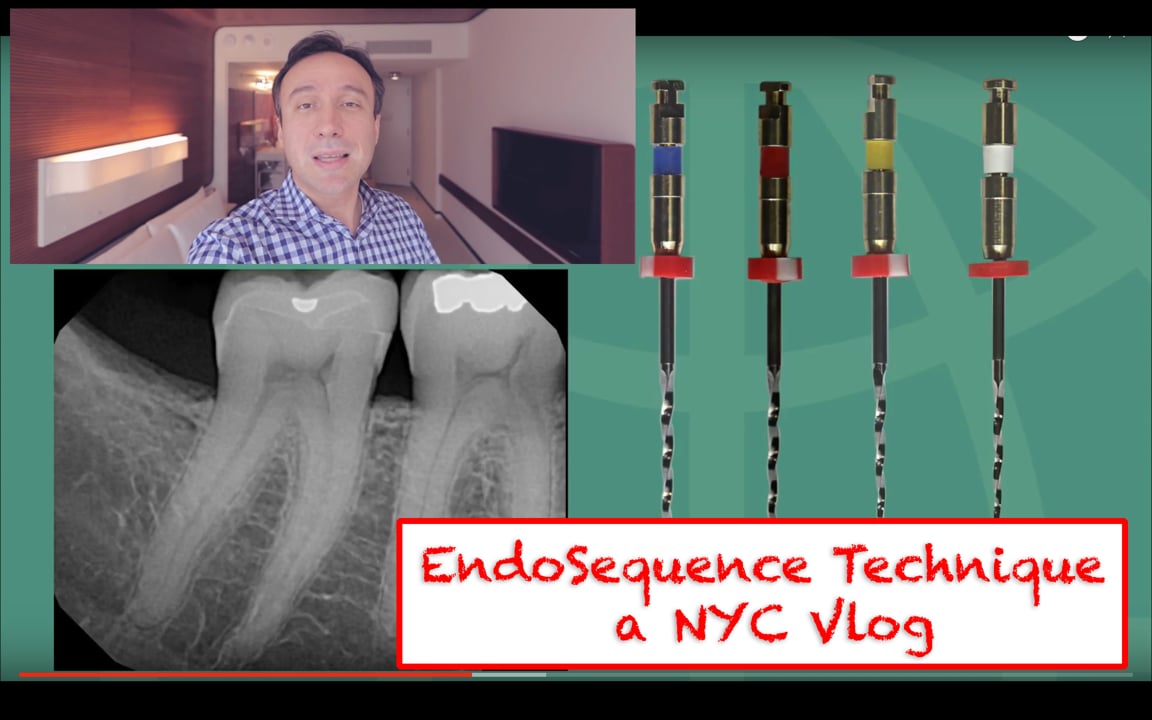 EndoSequence Instrumentation Technique in Molars (a Vlog in NYC
