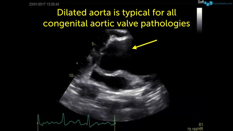 016 Answer: Congenital Aortic Valve