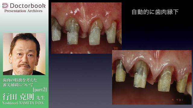 #2 接合上皮の特徴を使ったインプラント補綴症例