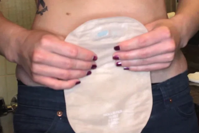 Change An Ostomy Bag - How to Video with Laura Cox