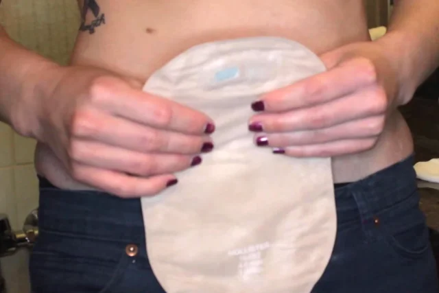 Colostomy/Ileostomy: Changing a Pouch 