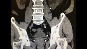 LITIASIS URINARIA MÚLTIPLE ASOCIADA A ESTENOSIS SEVERA DE NEOIMPLANTE URTERAL