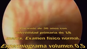 DESTECHAMIENTO TRANSURETRAL DE QUISTE DEL UTRÍCULO PROSTÁTICO PARA EL TRATAMIENTO DE LA AZOOSPERMIA OBSTRUCTIVA