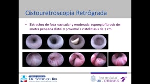 RECONSTRUCCIÓN MÍNIMAMENTE INVASIVA DE FOSA NAVICULAR: URETROPLASTÍA TRANSURETRAL MEDIANTE INLAY VENTRAL DE MUCOSA ORAL
