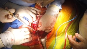 NEFRECTOMÍA RADICAL EN CANCER RENAL CON TROMBO EN NIVEL IV. ABORDAJE TORACO ABDOMINAL CON PARO CIRCULATORIO
