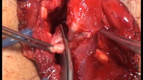 URETROPLASTIA BULBOMEMBRANOSA CON PRESERVACION DE ESFINTER EXTERNO, EN ESTRECHEZ URETRAL SECUNDARIA A CIRUGIA DEL ADENOMA DE PROSTATA. UNA NUEVA TECNICA