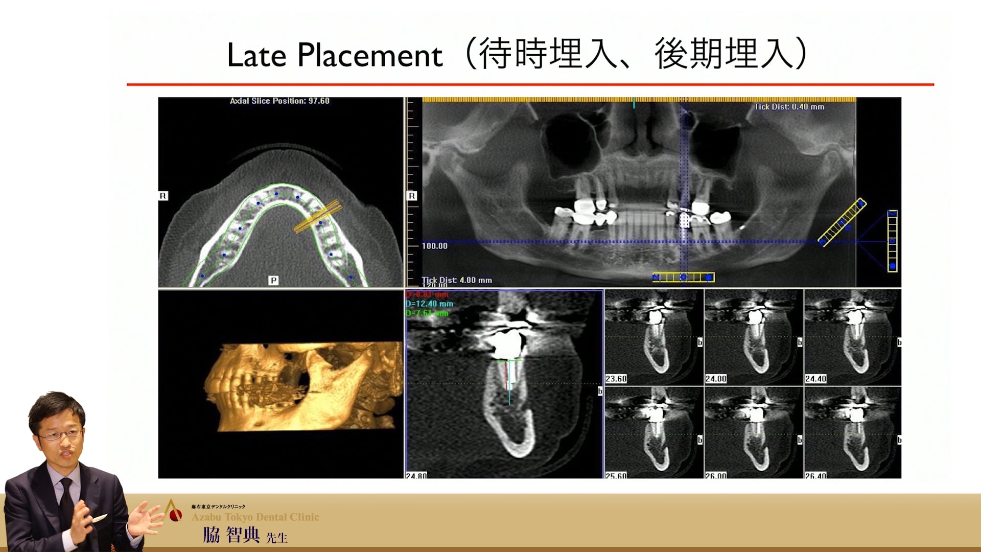 #3 Timing of Implant Placement