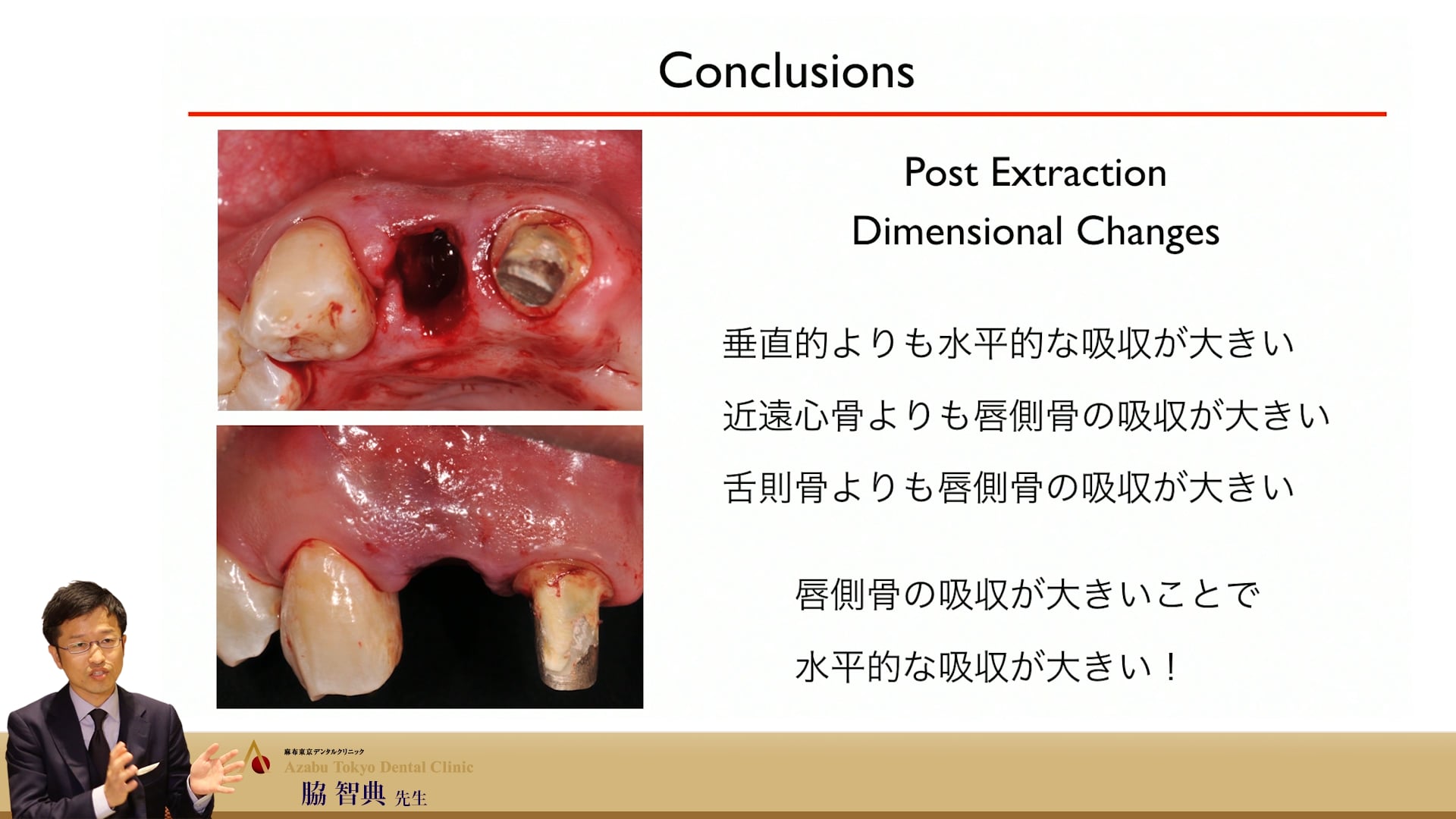 Part7【参加者専用】脇智典先生 審美領域のインプラント～歯頸線を綺麗に保つキーポイント～ 
