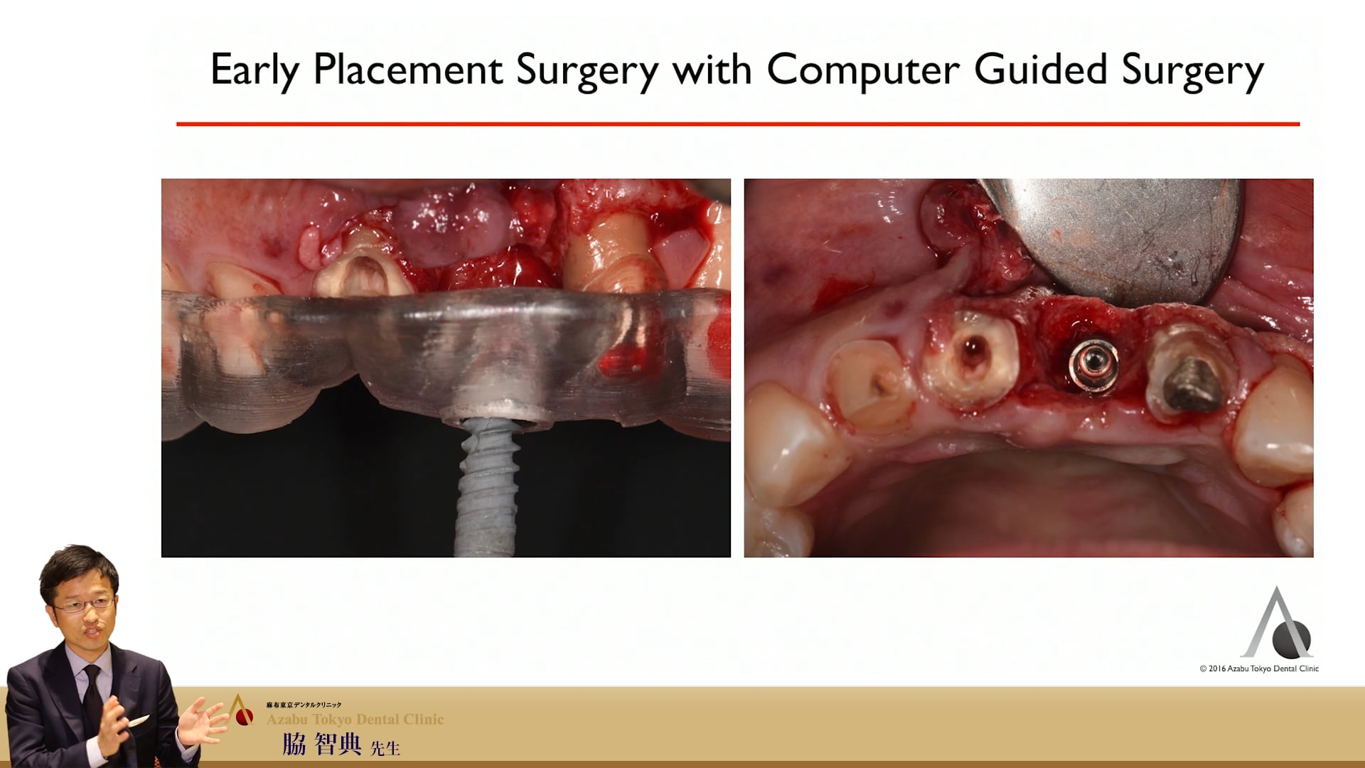 #8 Early Placement (part B)