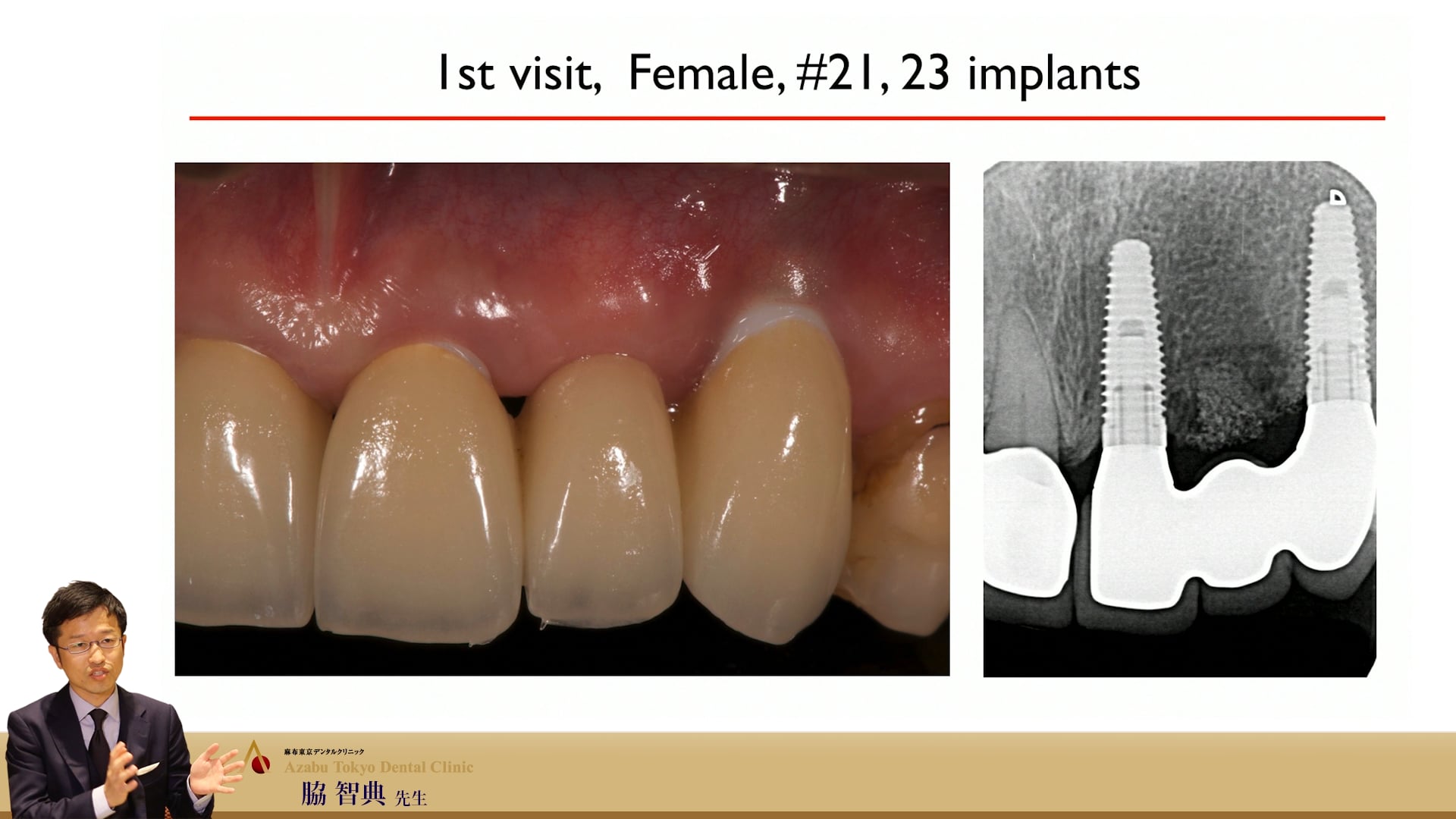 Part2【参加者専用】脇智典先生 審美領域のインプラント～歯頸線を綺麗に保つキーポイント～