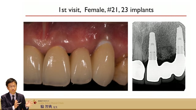 #2 Implant Size & Position