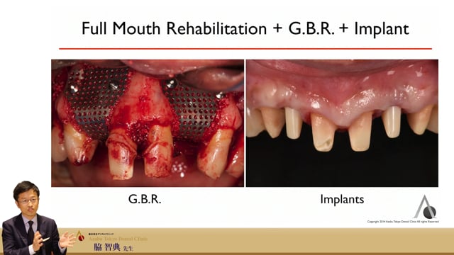 #6 Changing the Gingival Line in the Esthetic Zone