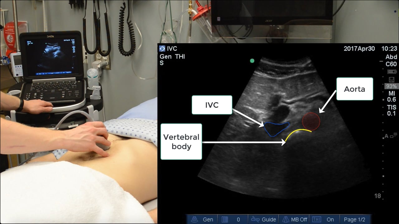 The IVC scan basics on Vimeo