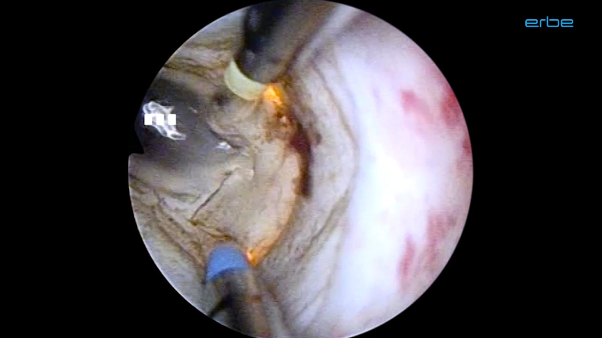 Bipolar TURP with VIO® 3
