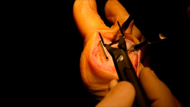 Arthrodèse de la première articulation métatarsophalangienne à l’aide d’agrafes de compression en nitinol Arcad