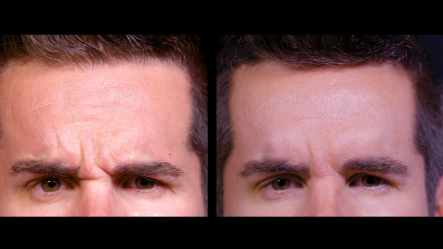 BTX: Complex Frown Forehead Injections - 
