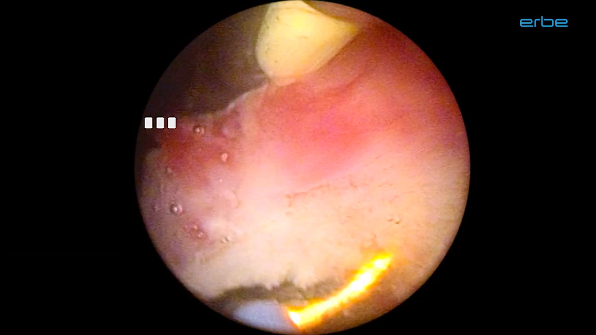 Bipolar TURBT with VIO® 3