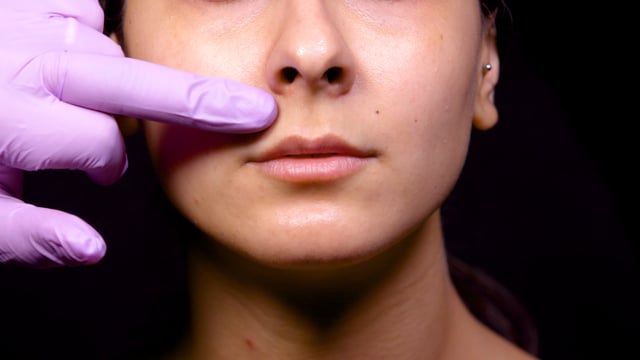 Lip Border Definition Injections