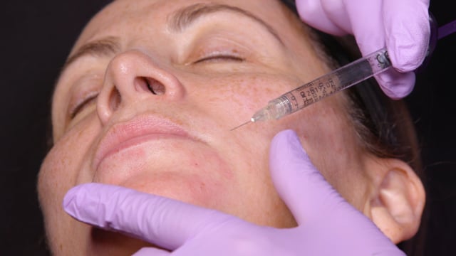 Dermal Filler Full Face Treatment - 